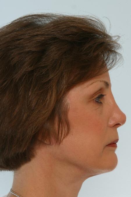 After image 3 Case #125866 - Facelift