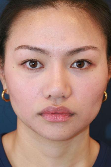 After image 1 Case #125676 - Open Rhinoplasty