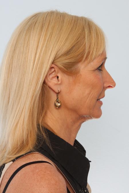 Before image 3 Case #125856 - Facelift