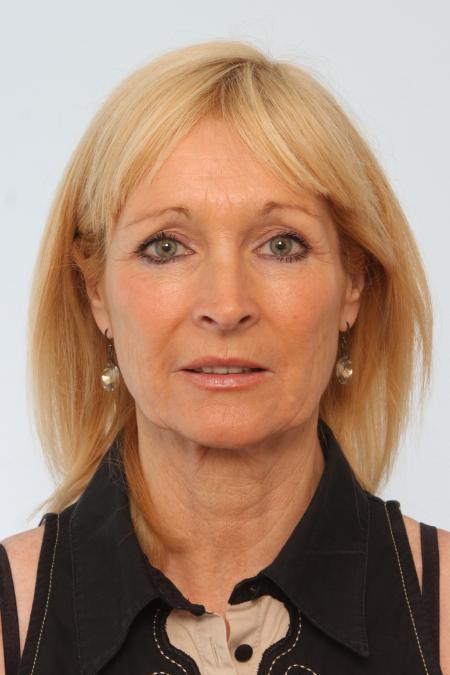Before image 1 Case #125856 - Facelift
