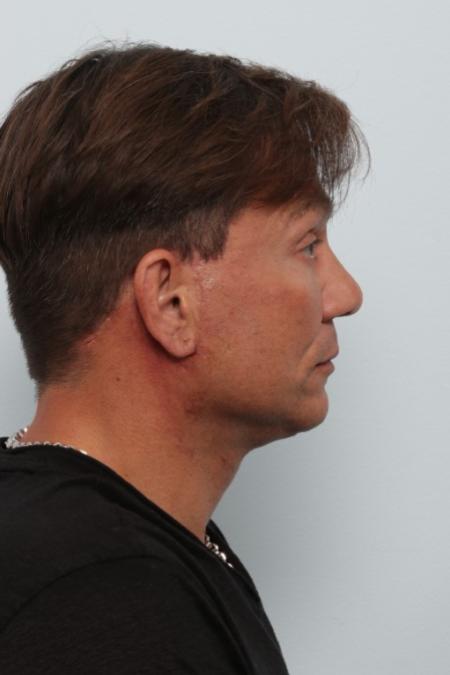 After image 3 Case #125846 - Facelift