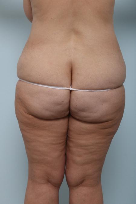 Before image 2 Case #125981 - Thigh Lift