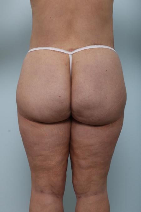 After image 2 Case #125981 - Thigh Lift