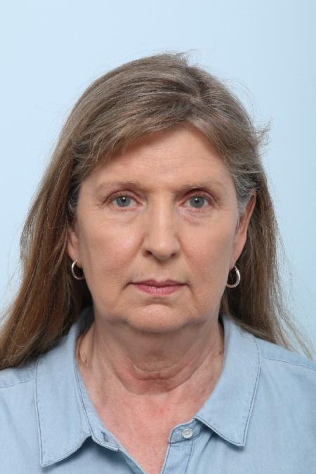 Before image 1 Case #125861 - Facelift