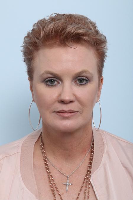 After image 1 Case #125906 - Upper Lip Lift