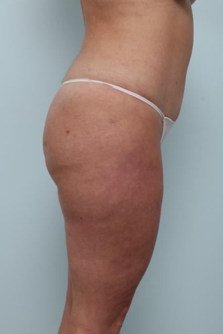 After image 3 Case #125956 - Tummy Tuck