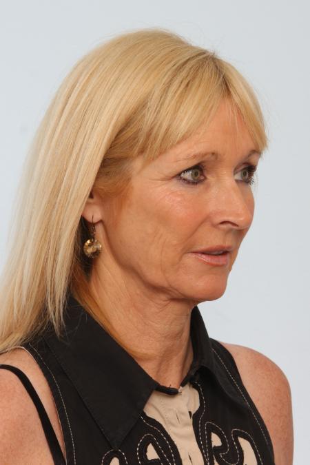 Before image 2 Case #125856 - Facelift