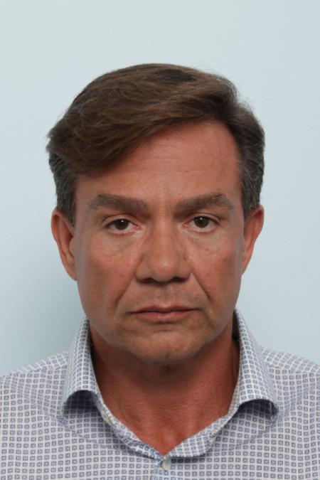 Before image 1 Case #125846 - Facelift