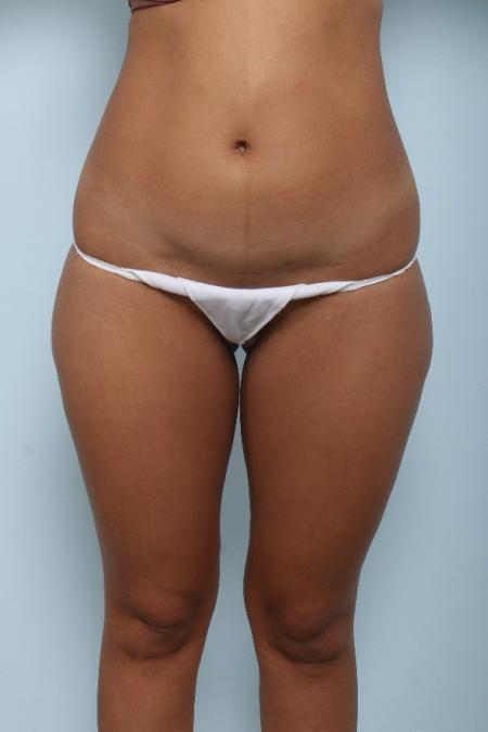 Before image 1 Case #125971 - Liposuction Before image 1 Case #125971 - Liposuction