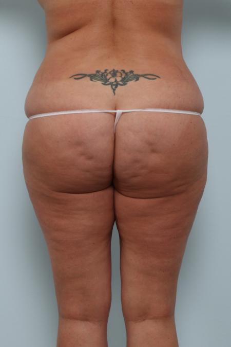 Before image 1 Case #125951 - Back Lift
