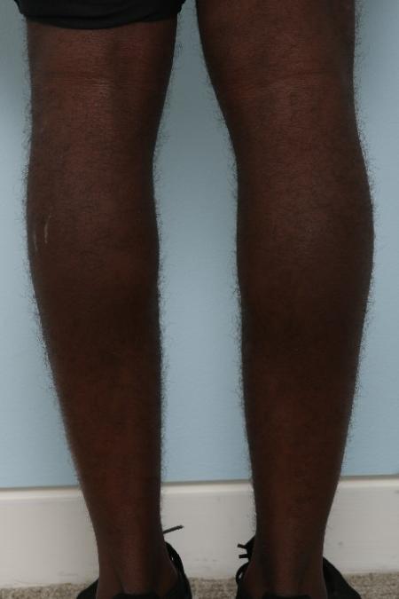 Before image 2 Case #125946 - Calf Implants
