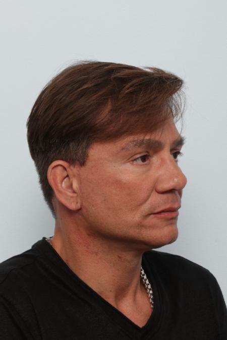 After image 2 Case #125846 - Facelift