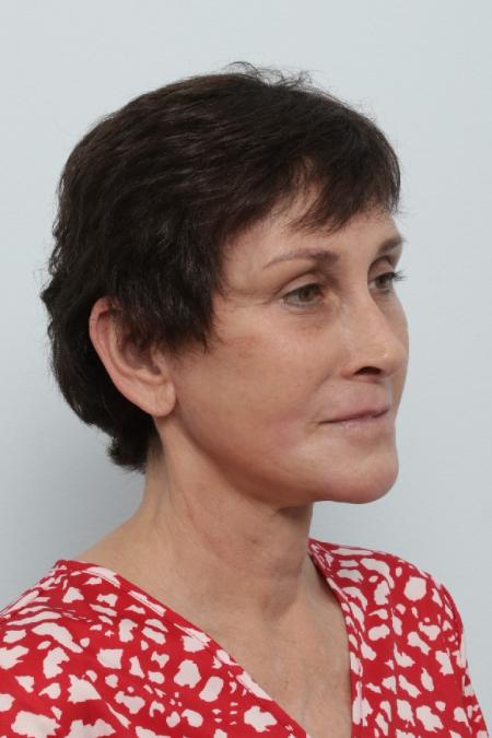 After image 2 Case #125841 - Facelift
