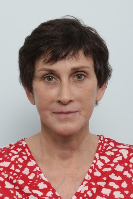 After image 1 Case #125841 - Facelift
