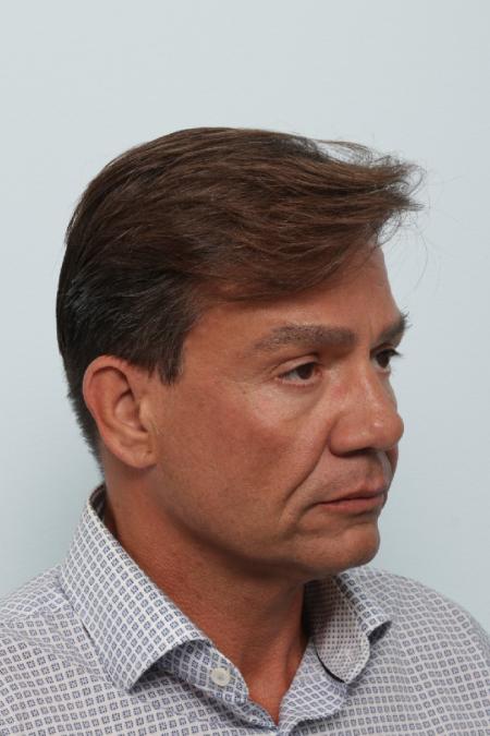 Before image 2 Case #125846 - Facelift