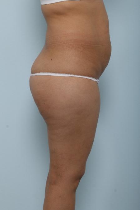 Before image 3 Case #125991 - Tummy Tuck Before image 3 Case #125991 - Tummy Tuck
