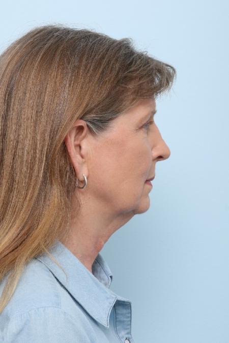 Before image 3 Case #125861 - Facelift