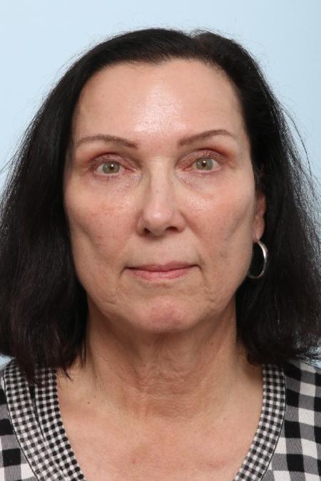 After image 1 Case #125911 - Upper and Lower Blepharoplasty