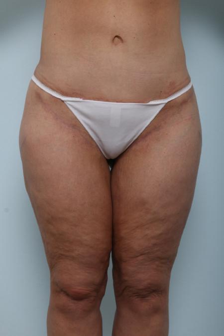 After image 1 Case #125981 - Thigh Lift