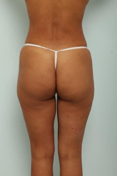 After image 4 Case #125971 - Liposuction After image 4 Case #125971 - Liposuction