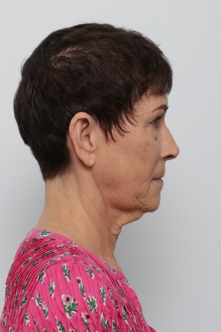 Before image 3 Case #125841 - Facelift