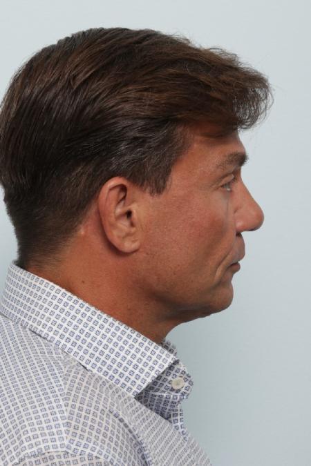 Before image 3 Case #125846 - Facelift