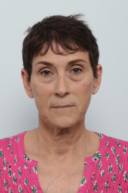 Before image 1 Case #125841 - Facelift