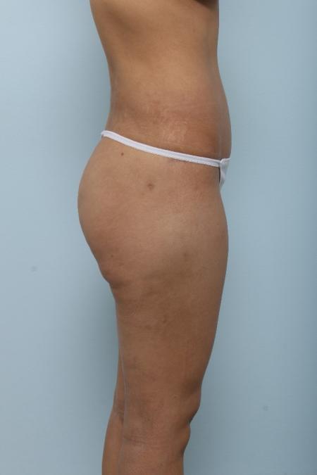 After image 3 Case #125991 - Tummy Tuck After image 3 Case #125991 - Tummy Tuck