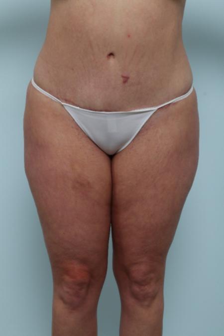 After image 1 Case #125956 - Tummy Tuck