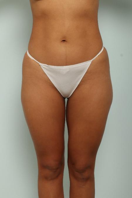 After image 1 Case #125971 - Liposuction After image 1 Case #125971 - Liposuction