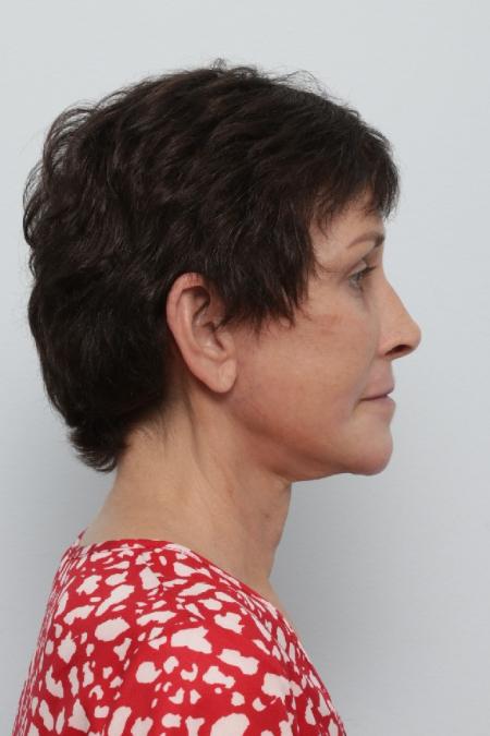 After image 3 Case #125841 - Facelift