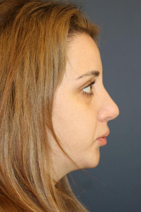 After image 3 Case #126001 - Female Rhinoplasty After image 3 Case #126001 - Female Rhinoplasty