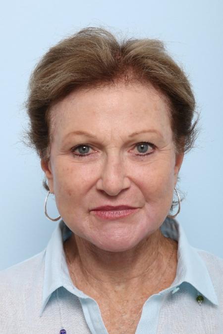After image 1 Case #125851 - Facelift