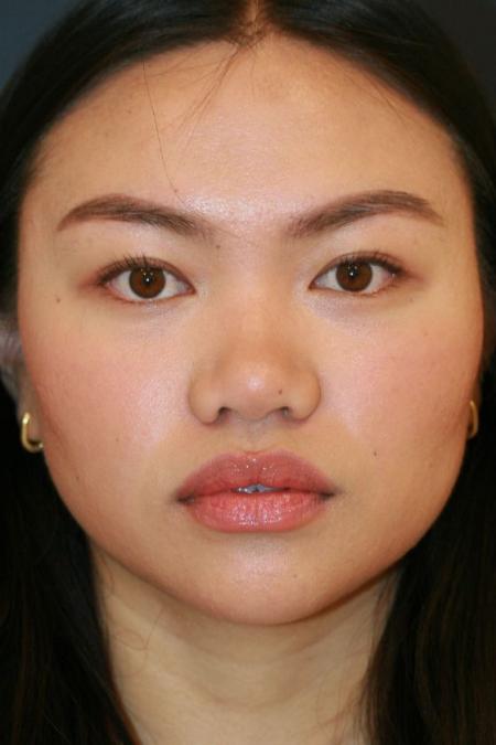 Before image 1 Case #125676 - Open Rhinoplasty