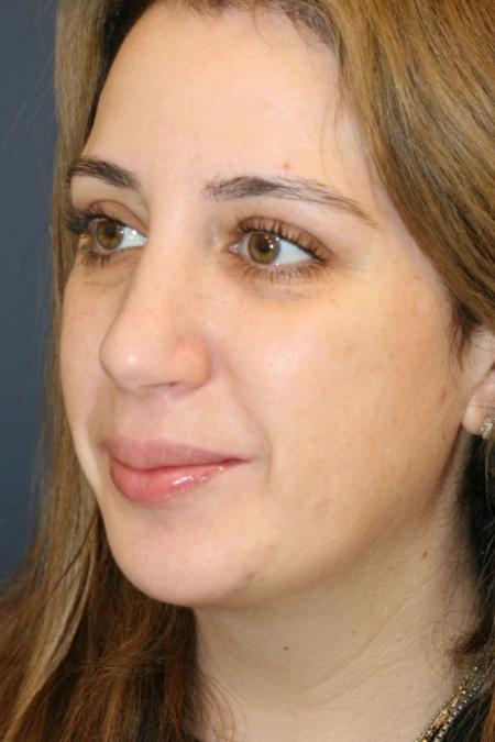 After image 2 Case #126001 - Female Rhinoplasty After image 2 Case #126001 - Female Rhinoplasty