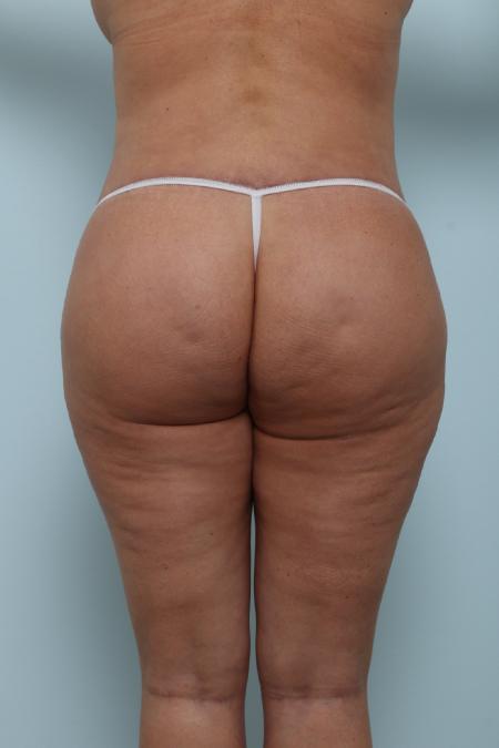 After image 1 Case #125951 - Back Lift