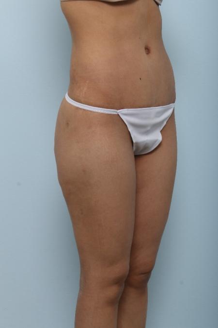After image 2 Case #125991 - Tummy Tuck After image 2 Case #125991 - Tummy Tuck