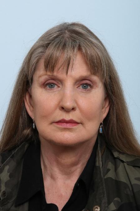 After image 1 Case #125861 - Facelift