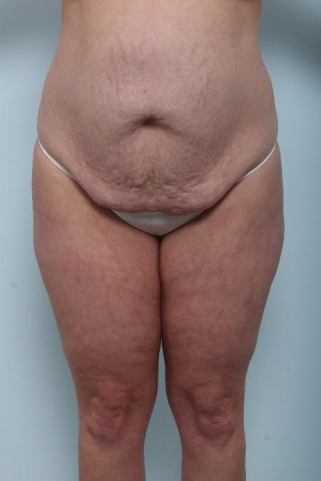 Before image 1 Case #125956 - Tummy Tuck