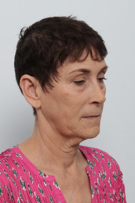 Before image 2 Case #125841 - Facelift