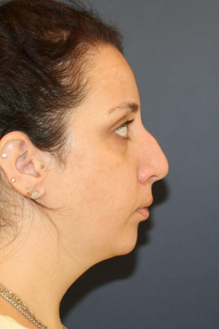 Before image 3 Case #126001 - Female Rhinoplasty Before image 3 Case #126001 - Female Rhinoplasty