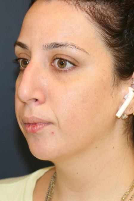 Before image 2 Case #126001 - Female Rhinoplasty Before image 2 Case #126001 - Female Rhinoplasty