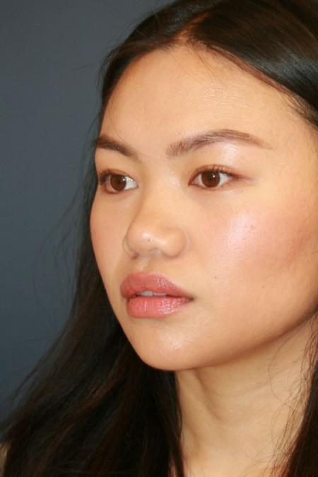 Before image 2 Case #125676 - Open Rhinoplasty