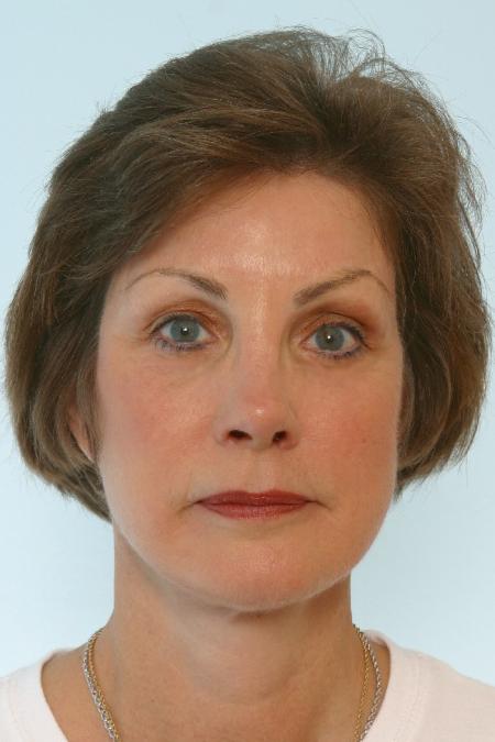 After image 1 Case #125866 - Facelift