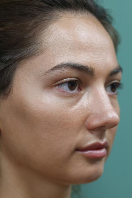 After image 2 Case #126811 - Reduction Rhinoplasty