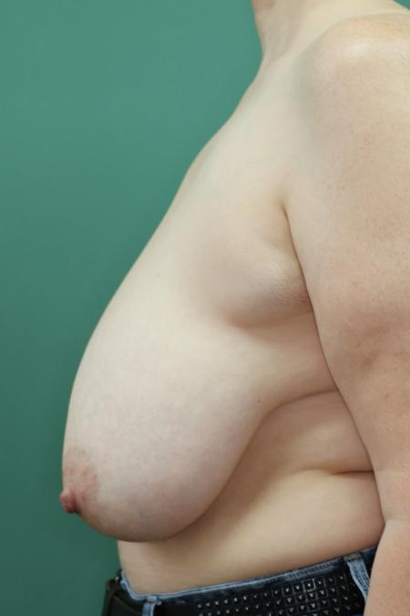 Before image 5 Case #126806 - Breast Ptosis