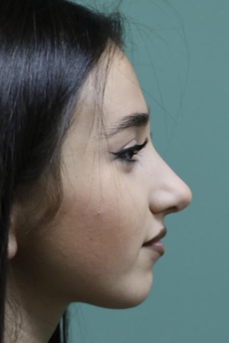 After image 4 Case #126786 - Nasal Deviation Syndrome