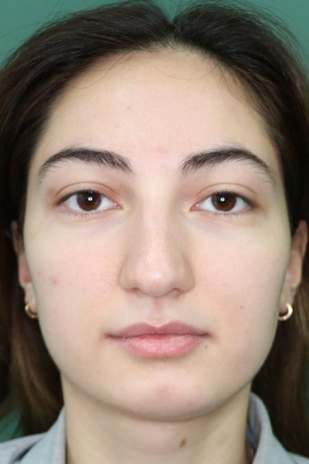 Before image 1 Case #126811 - Reduction Rhinoplasty