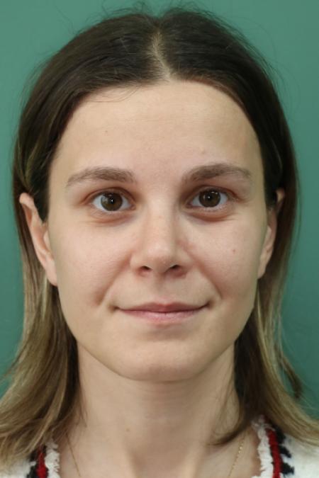 After image 1 Case #122911 - Primary Septorhinoplasty