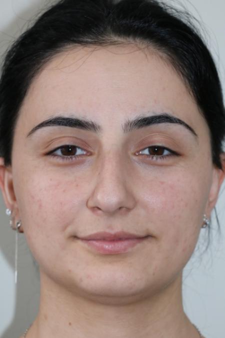 Before image 1 Case #122581 - Primary Rhinoplasty